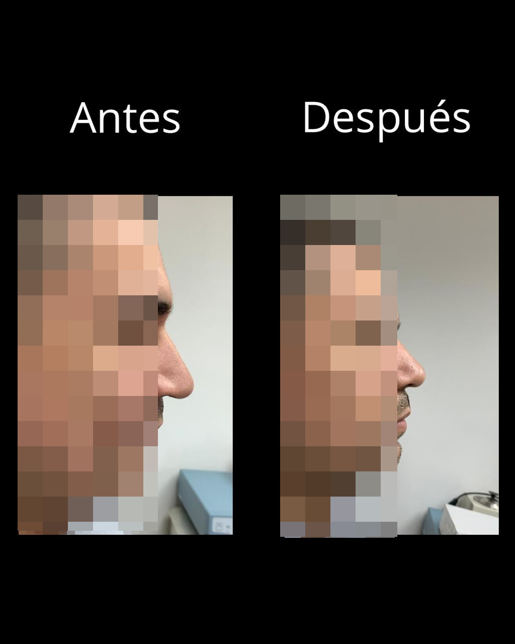 Antes